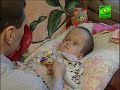 Таких непростых случаев, как у девятилетнего Тимоши Акижанова, можно найти с трудом даже на территории нашей немаленькой России. С первого взгляда заметно, какая большая у ребенка голова. И даже трудно представить, что она такого размера с первого года жизни Тимоши. В первые часы жизни у Тимоши произошло кровоизлияние в мозг, образовалась гематома и начала очень сильно прогрессировать гидроцифалия. Не раз Людмиле и Ринату (родителям ребенка) говорили, что совсем скоро их ребенок умрет, слишком уж сильная у него гидроцифалия. К тому же, спустя некоторое время у Тимоши начались судороги. Из-за тяжелого состояния мальчика врачи долго не решались установить ребенку шунт, специальный прибор, отводящий лишнюю жидкость из головы.