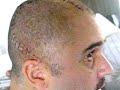 Elio Cranioplastia