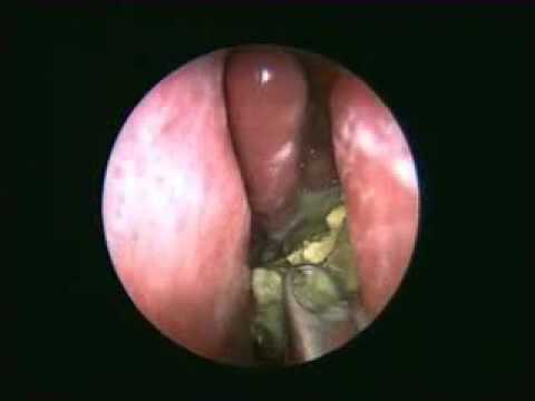 how to kill sinus fungus