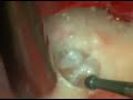 Intervento di Endodonzia Chirurgica, Endodontic Surgery Intervento di Endodonzia Chirurgica, Endodontic Surgery