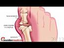 Insidermedicine in 60 - May 29, 2008 Pancreatic Cancer, Childhood