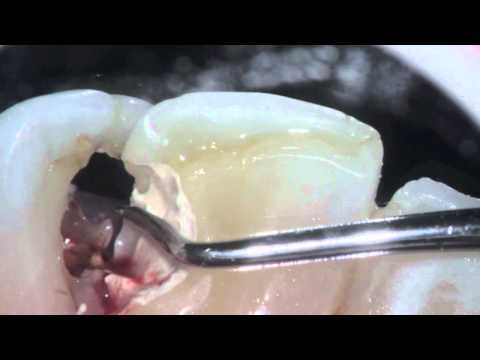 Prep start H2O painless fillings # 9 #10