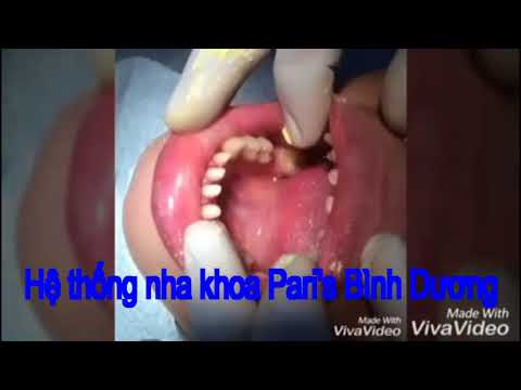 Chị Phương Thuận An Bình Dương đến Nha Khoa Pari's..đã tự tin hơn với nụ cười của mình