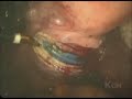 Total Laparoscopic Hysterectomy