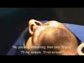 Wisdom teeth extraction Wisdom teeth extraction