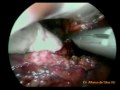 LAPAROSOCPIC ADRENALECTOMY