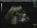Baby P