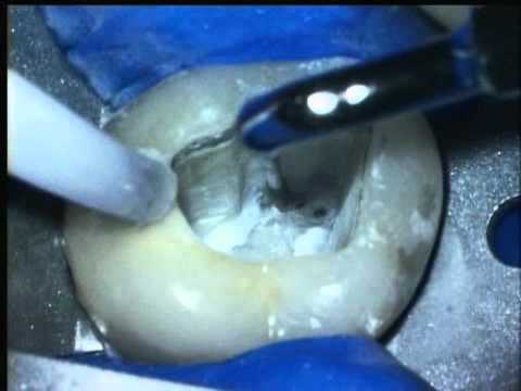 Disassembly & Missed Canals See video
