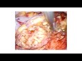 Robot-Assisted Prostatectomy