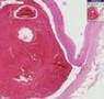 Histopathology Aorta--Dissection, cystic medial degeneration