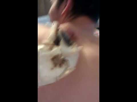 how to draw out a cyst