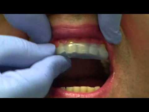 how to whiten night guard