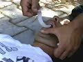 inserimento della cannula