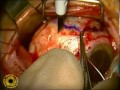 Eye cancer, eye neoplasm operation