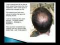 Hair Loss Information
