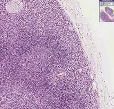 Histopathology Lymph node--Nodal ...
