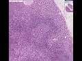 Histopathology Lymph node--Nodal marginal zone B-cell lympho
