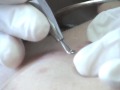 Skin Classic acne cyst treatment  part 2