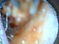 Ear Wax removal 4
