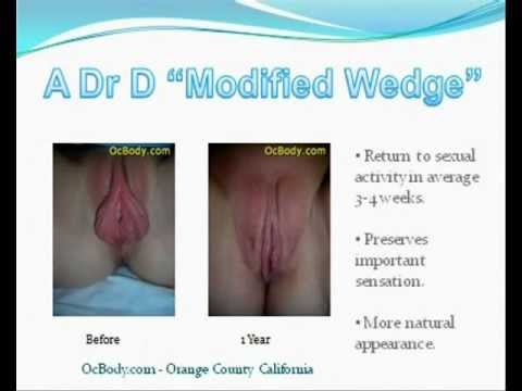 how to perform your own labiaplasty