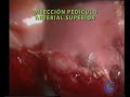 Feocromocitoma abordaje laparoscópico Feocromocitoma abordaje laparoscópico