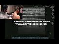 Ultrasound guided thoracic paravertebral block workshop