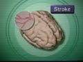 Heart Attack and Stroke Heart Attack and Stroke