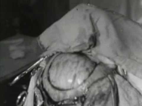 Historische Operationsvideos aus den 1930ern