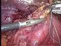 duodenal carcinoid duodenal carcinoid