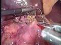 duodenal carcinoid