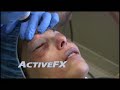 ActiveFX and DeepFX laser skin rejuvenation ActiveFX and DeepFX laser skin rejuvenation