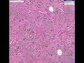 Histopathology Skin--Cellular Blue Nevus