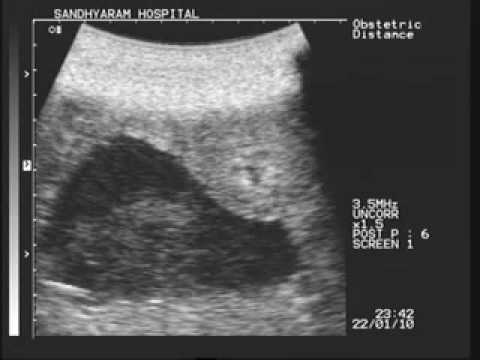 how to measure amniotic fluid