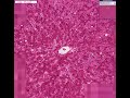 Histopathology Liver --Amyloidosis