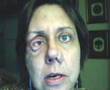 Neurofibromatosis-Ty