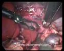 Gastric banding and a benign mass