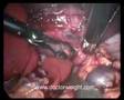 Gastric banding and a benign mass
