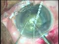 Phacoemulsification hard cataract horizontal direct chop Phacoemulsification hard cataract horizontal direct chop