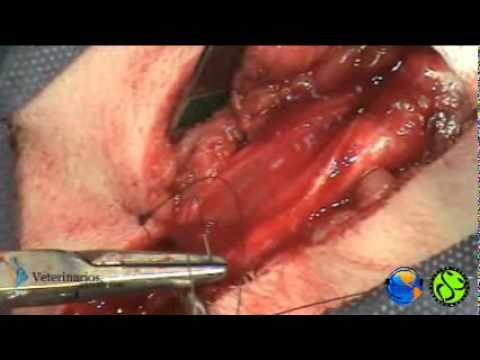 amputacion -