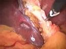 laparoscopic cholecystectomy Cholecystectomy