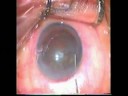 sutureless small incision cataract extraction prof Ayman sutureless small incision cataract extraction prof Ayman