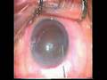 sutureless small incision cataract extraction prof Ayman