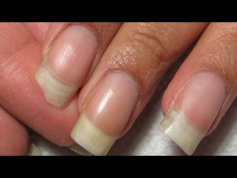 how to repair broken nail
