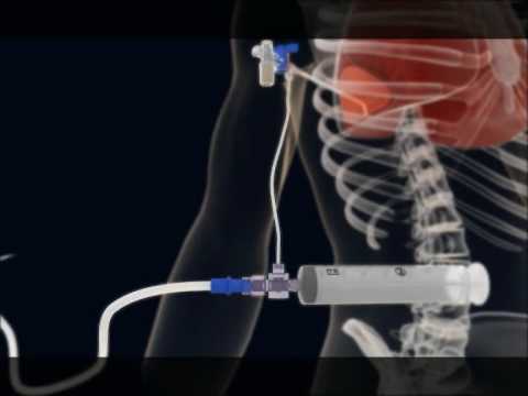 how to cure pleural effusion