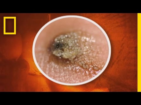 how to treat jigger infestation