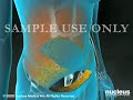 3D Medical Animation: Breast Reconstruction after a Mastectomy 3D Medical Animation: Breast Reconstruction after a Mastectomy