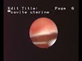 hysteroscopic-aspect-of-intra-uterine-device.html