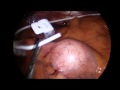 Gastric Banding - Straightforward Laparoscopic Method