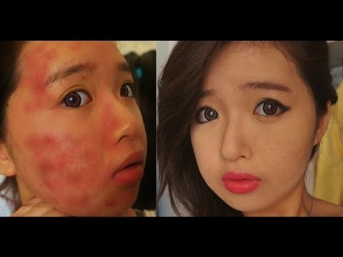 Acne Coverage Foundation Routine for Dry Skin