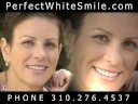Laser Teeth Whitening Beverly Hills California, Los Angeles Teeth Whitening